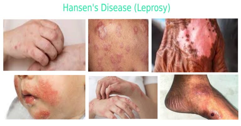 Cure for Hansen's Disease (Leprosy) _Types, Symptoms, Causes, Diagnosis and Treatment